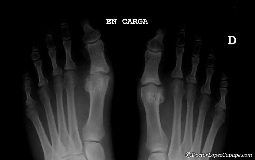 radiografia-dedo-pie-roto-actualizado-marzo-2024